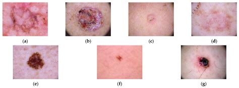 Lesion .